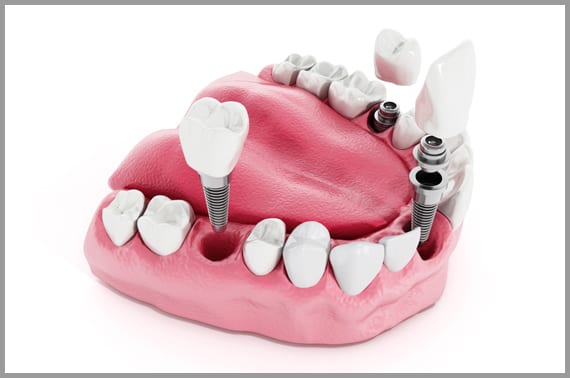 dental-implants-banner