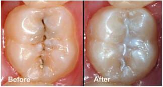 fissure-before-after
