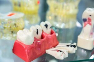 Dental Fillings
