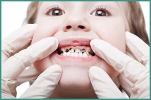 tooth decay