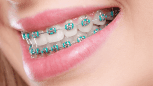 dental braces