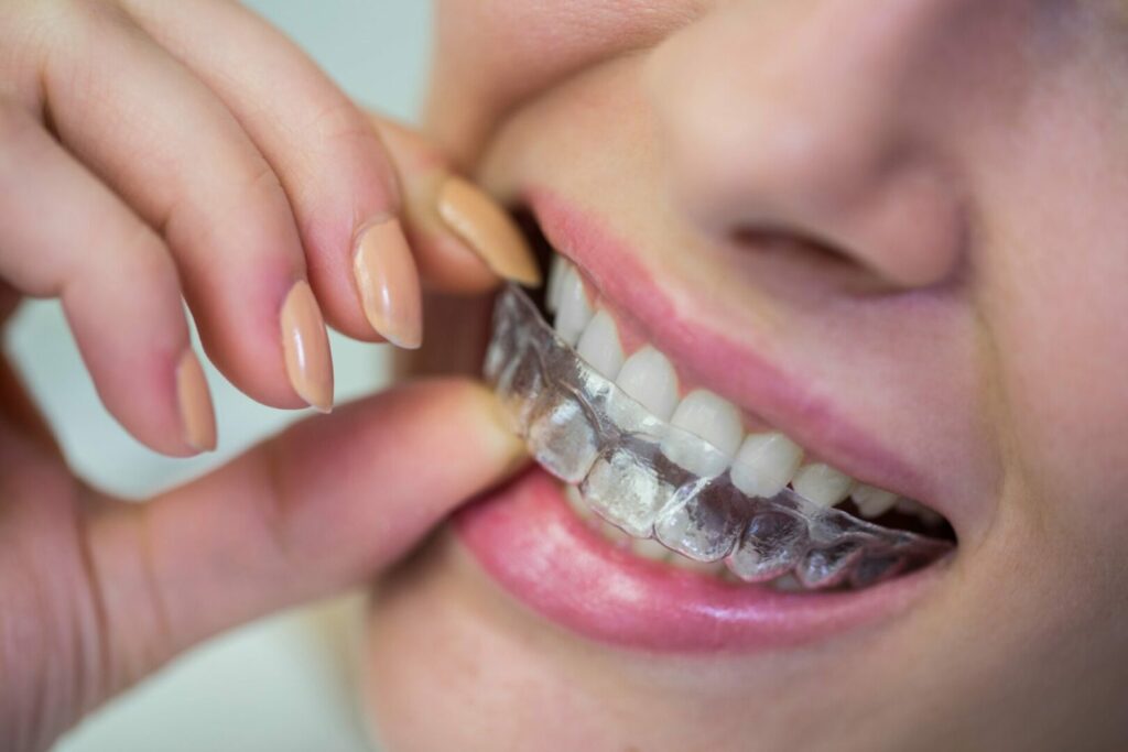 invisalign invisible braces hampton park