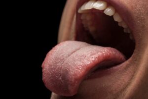 dry mouth