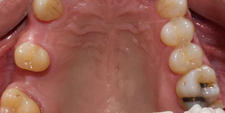 Before-Dental-Implant-at-EDC.jpg Before-Dental-Implant-at-EDC.jpg