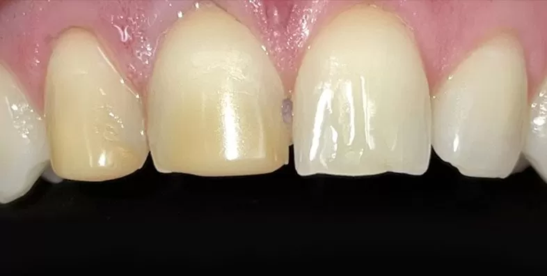 Before-Porcelain-Veneer-Treatment.jpg Before-Porcelain-Veneer-Treatment.jpg