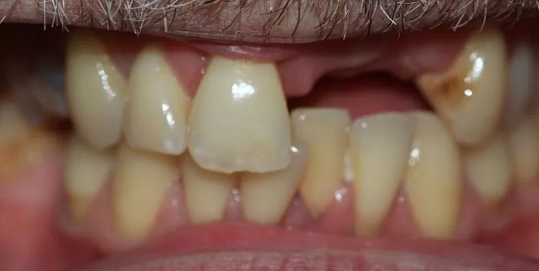 Before-crown-bridge-treatment.jpg