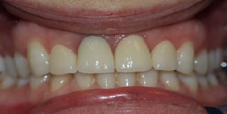 Crown-after-treatment.jpg