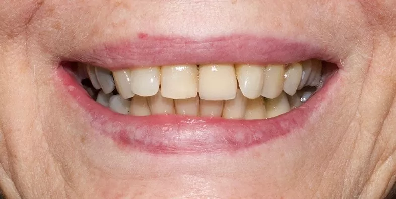 Post-op-Smile.jpg