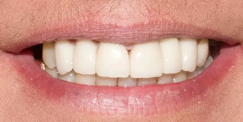 Smile-Post-op.jpg