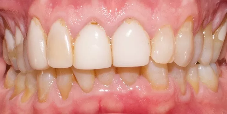Veneers-before.jpeg Veneers-before.jpeg