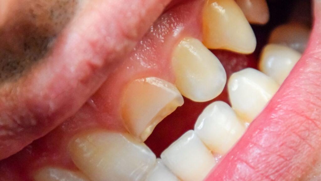Broken Tooth image