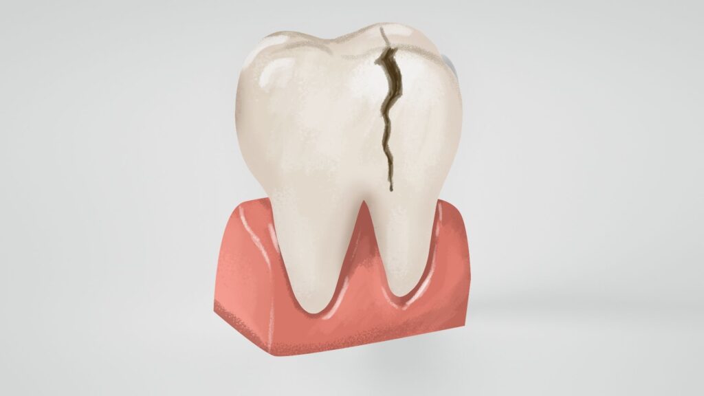 cracked tooth image