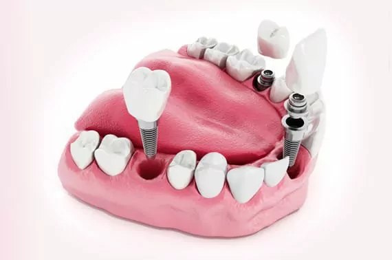 dental implants hampton park