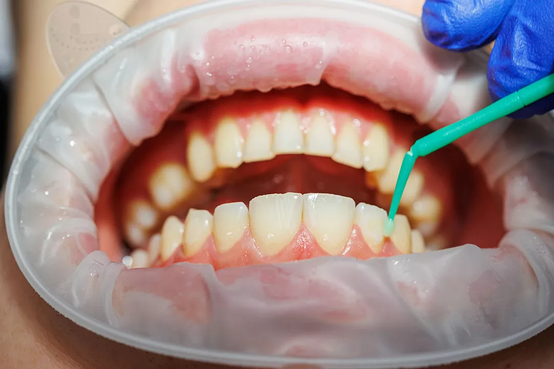 Why You Shouldn’t Ignore Bleeding Gums