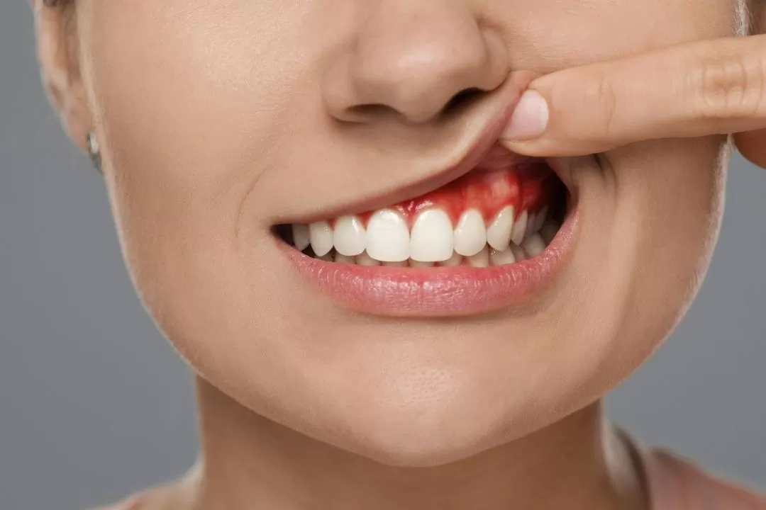 How Early Gum Disease Affects Your Smile – And What to Do