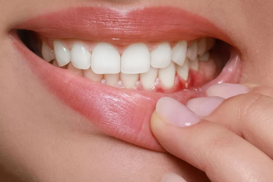 Oral Cancer Screening: What You Should Know