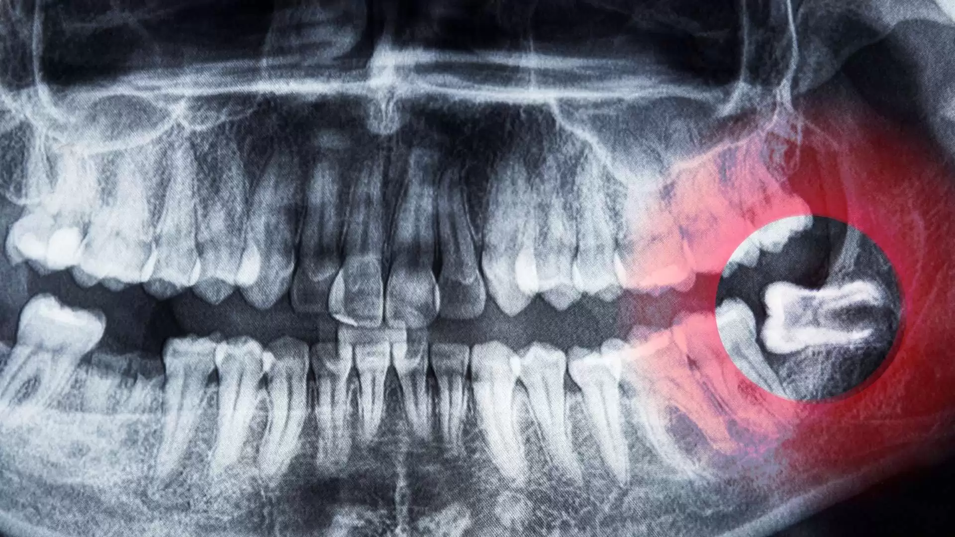 Wisdom Teeth: Monitoring vs Removal – What’s Best for You?
